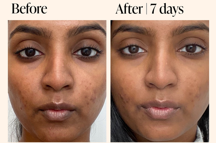 model before and after using Superhue for 7 days with dark spots lightened