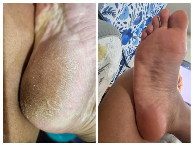 left: bottom of reviewer's crusty, callused foot / right: after using the gel, same reviewer's foot looking smooth and soft