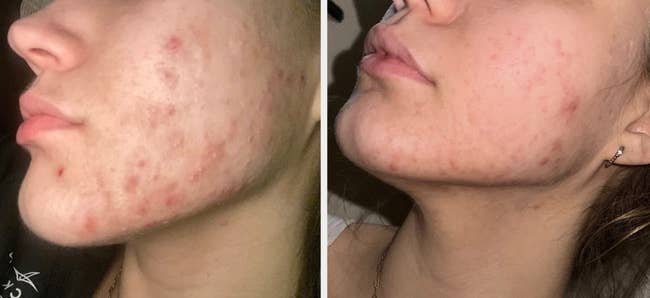 reviewer skin before using Blume oil with red, inflamed acne / after using it, looking smoother with less redness