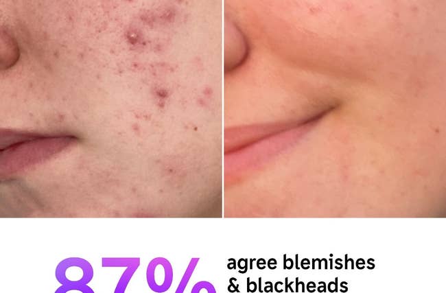 Before and after close-up of a model's cheek showing acne treatment results