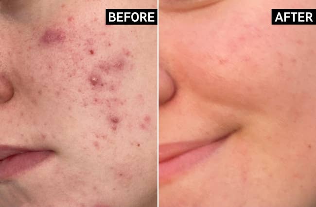 Before and after close-up of a model's cheek showing acne treatment results