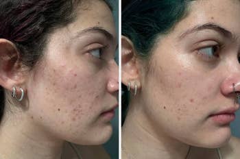 Side-by-side comparison of a person's skin before and after using a skincare product