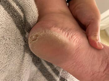 reviewer's foot with calluses