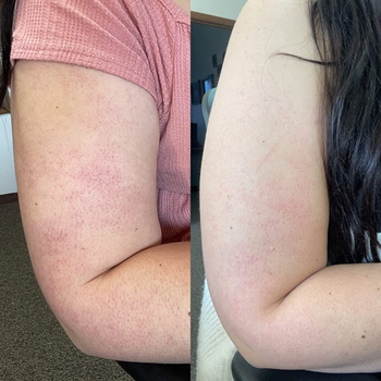 reviewer's before and after of their arm that's been treated with the product