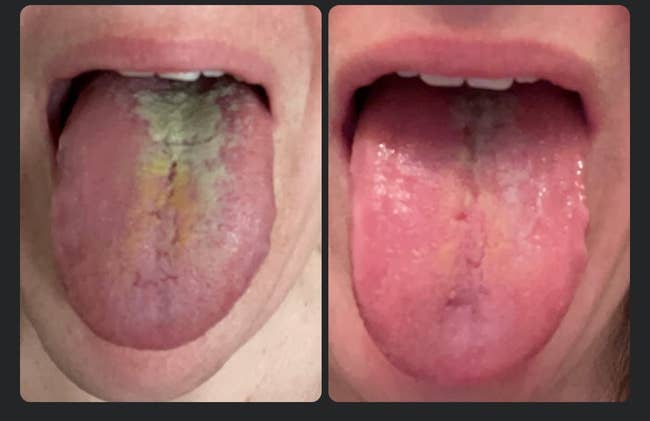 left: reviewer's tongue with thick coating before using scraper / right: same reviewer's tongue clean after using scraper