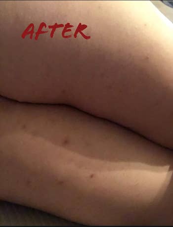 Reviewer after photo of thighs with less razor bumps