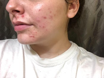 before image of reviewer with acne all over left side of face