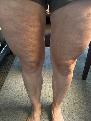 之前的照片,一位60岁的评论家的腿和大腿脂肪团”class=