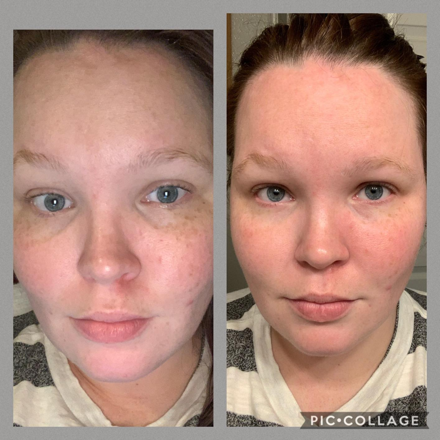 before image of reviewer with dark sunken in under eyes and after image of the same reviewer with lighter under eyes