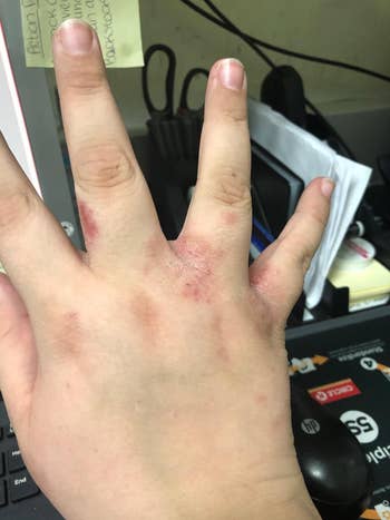 before reviewer image of eczema flare up on fingers