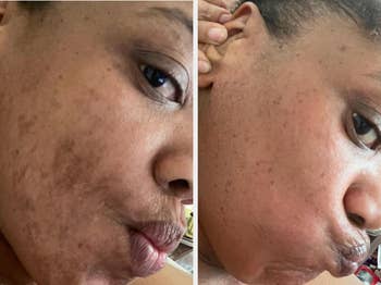 Two close-up selfies of a person's look   showing disposable   tegument  improvement, highlighting a skincare product's effectiveness successful  reducing blemishes