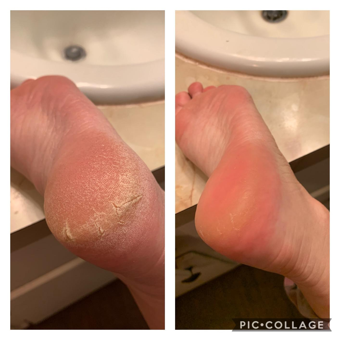 Reviewer showing before and after results of using O'Keefe's Healthy Feet foot cream