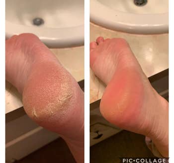 Reviewer showing before and after results of using O'Keefe's Healthy Feet foot cream