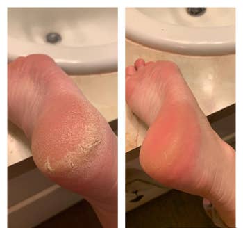 Reviewer showing before and after results of using O'Keefe's Healthy Feet foot cream