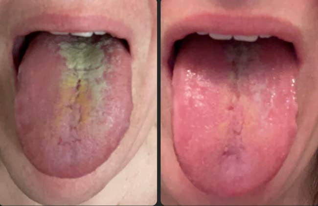 Close-up comparison of a tongue before and after brushing