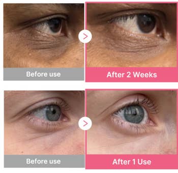 Before and aft close-ups amusement reduced under-eye wrinkles aft 2 weeks and 1 week of merchandise use, demonstrating the product's effectiveness