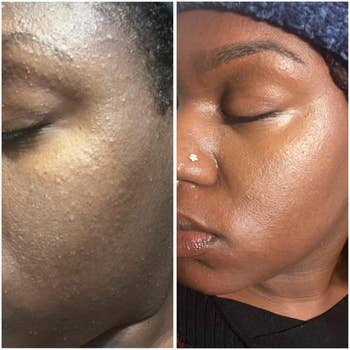 Close-up of a person's look earlier and aft skincare treatment, showing improved tegument texture and reduced blemishes