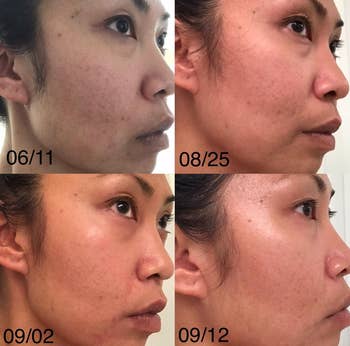 reviewer skin progress photos showing skin gradually get more clear