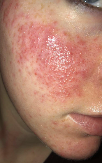 reviewer showing acne on their cheek