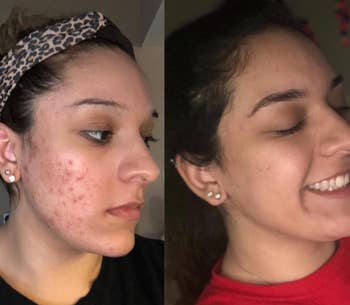 reviewer before and after photos, showing their skin with acne on the left and their skin looking much clearer after using the cleanser on the right