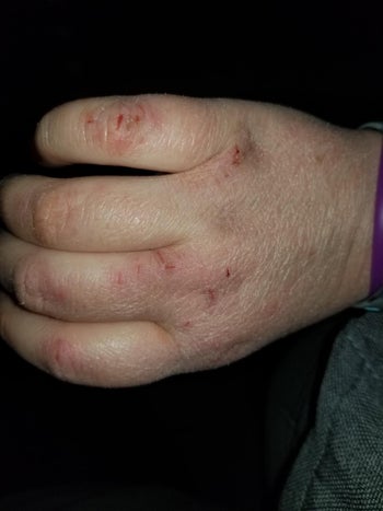 A reviewer showing their hands before using the cream and their hands are dry with cuts and scrapes 