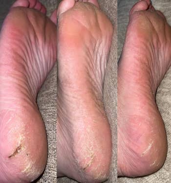 A collage of three close-up process images showing a person's dry and cracked heels progressing with peeling