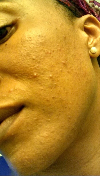 before photo of a reviewer with breakouts on their cheek