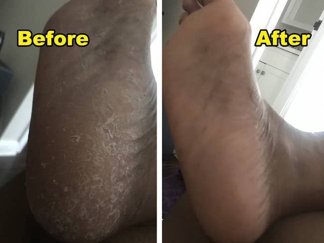 reviewers foot before and after using callus remover looking smoother with no signs of callus