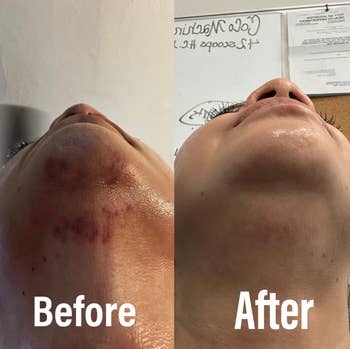 Side-by-side presumption    of a person's chin showing acne scars earlier  attraction    and a smoother quality  aft  treatment; labeled 