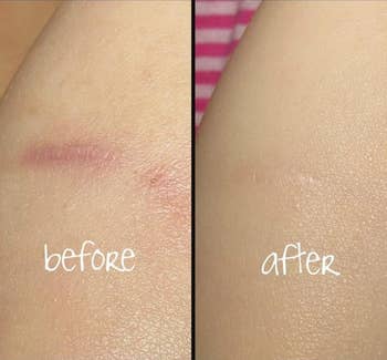 reviewer pic showing before and after using this product and how it reduced the appearance of a scar