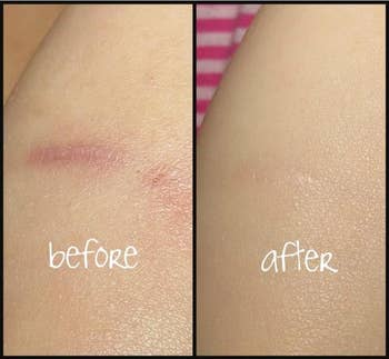 reviewer pic showing before and after using this product and how it reduced the appearance of a scar