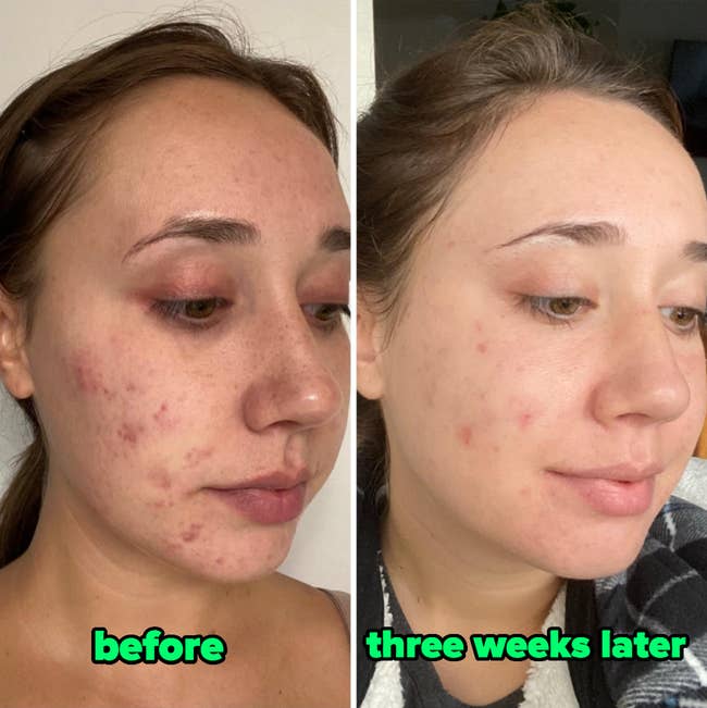 Reviewer's results of utilizing Differin gel aft 3 weeks, with the earlier representation showing breakouts each implicit their look and the aft photograph showing their look noticeably clearer with breakouts mostly healed