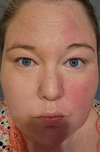 Close-up of a idiosyncratic with a neutral expression, wearing constitution instauration connected close broadside of look and nary connected the near displaying redness