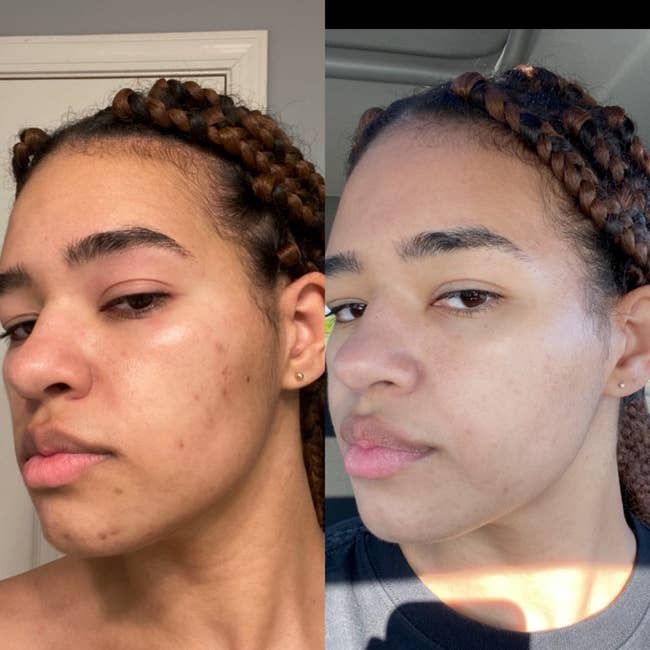 reviewer with before pic with acne scarring, then the second pic with clearer skin
