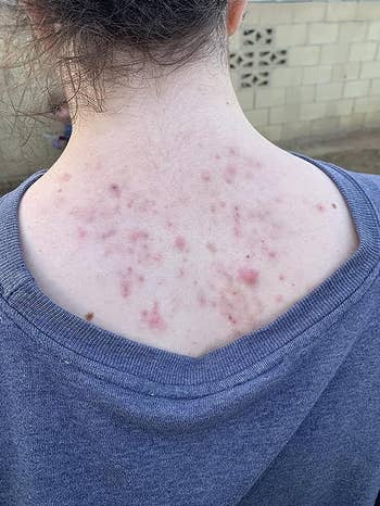 Reviewer with back acne before using wash