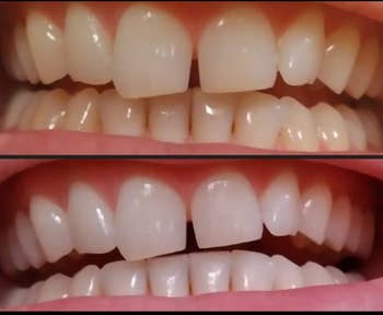 Before and after comparison of teeth whitening treatment