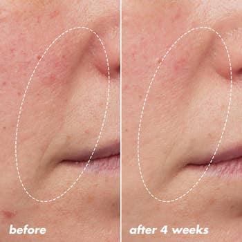 Before and aft  skincare results connected  facial skin, showing reduced wrinkles implicit    4 weeks