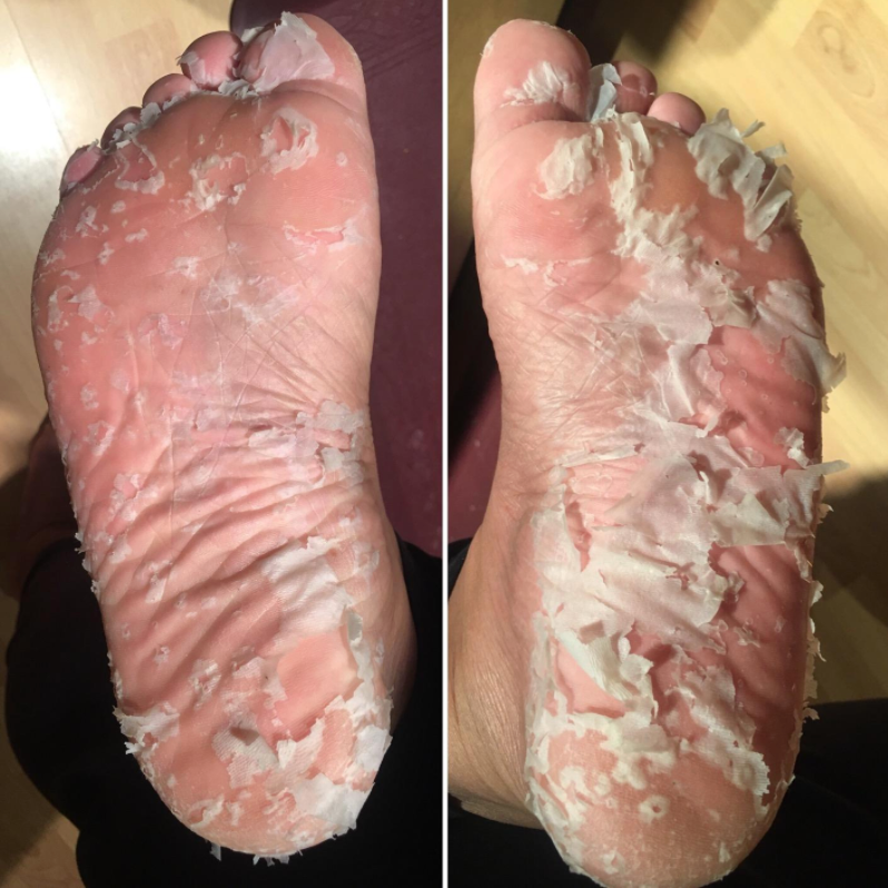 feet peeling because of the mask 