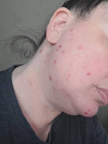 a reviewer with acne on their cheek 