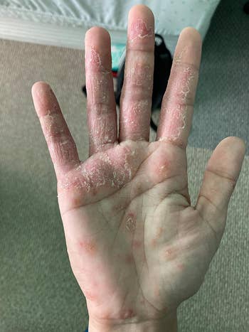 before image of a reviewer's hand covered in dry and flaking skin