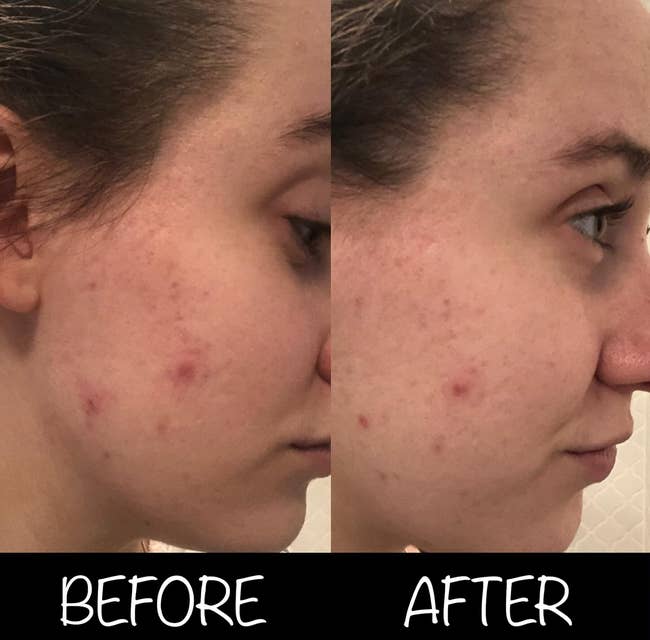reviewer before with a large pimple on their cheek and after with it smaller and less red