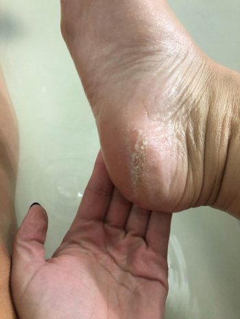 reviewer's bottom of foot with built up calluses