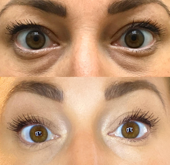 reviewer showing a before and after for the concealer 