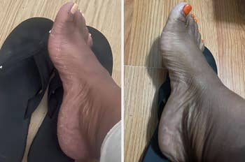 Before and after images of feet, one red and one healed