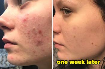 Two side-by-side close-up images show a person's cheek with acne before and after one week of treatmenr