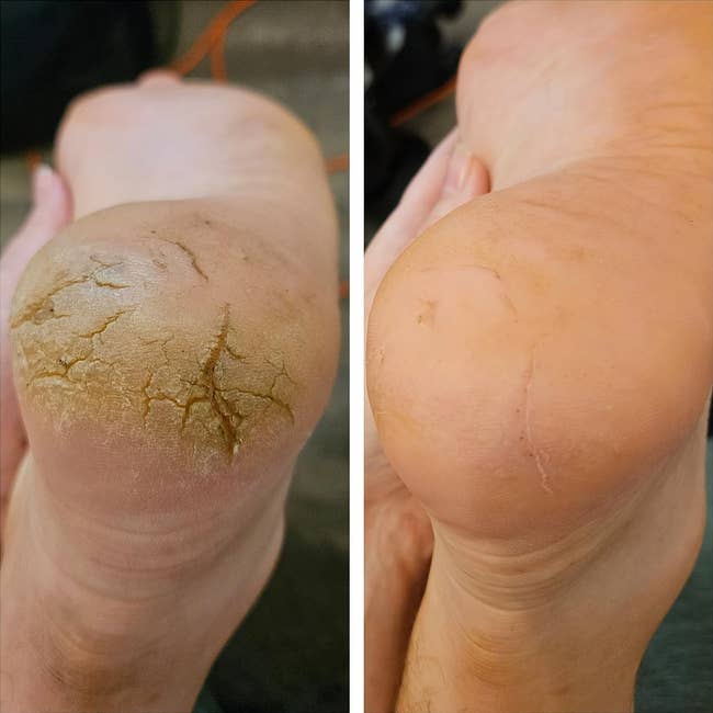 before/after of a callused foot that's been softened using the gel