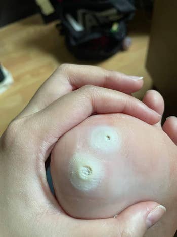 Hand holding a ft  with 2  disposable   plantar warts connected  the heel