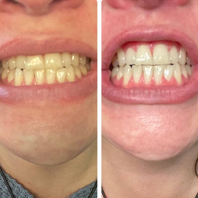 before/after of reviewer's teeth looking yellow then noticeably whiter