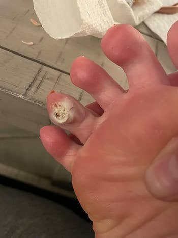 Gambar close-up sebelum kutil pada jari kaki