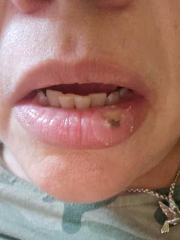 Close-up of a person's lips with a visible cold sore n the lower lip